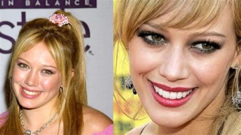 A Look At Hilary Duff’s History With Plastic Surgery